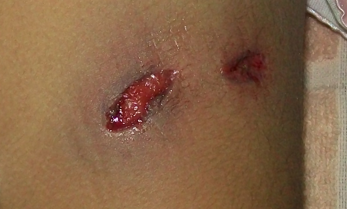 Entry wound and exit wound